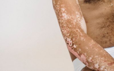 Psorijeza – Kako stati na kraj ovoj kožnoj bolesti?