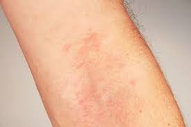 Atopijski dermatitis – sve što trebate znati