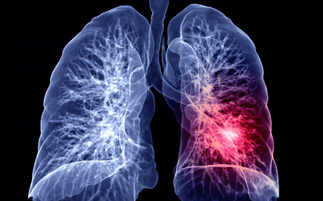 Što je embolija pluća?