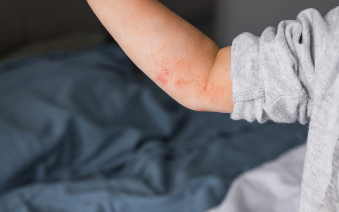 Liječenje atopijskog dermatitisa