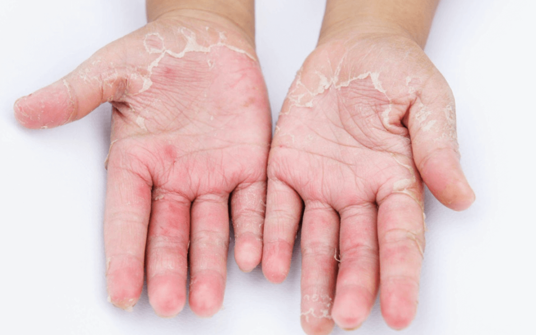 Što je kontaktni dermatits