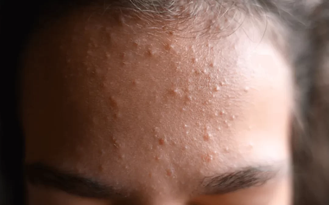 Komedoni na licu u odrasloj dobi – zašto se pojavljuju i nakon dvadesetih?