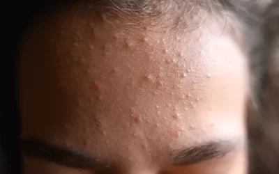 Komedoni na licu u odrasloj dobi – zašto se pojavljuju i nakon dvadesetih?